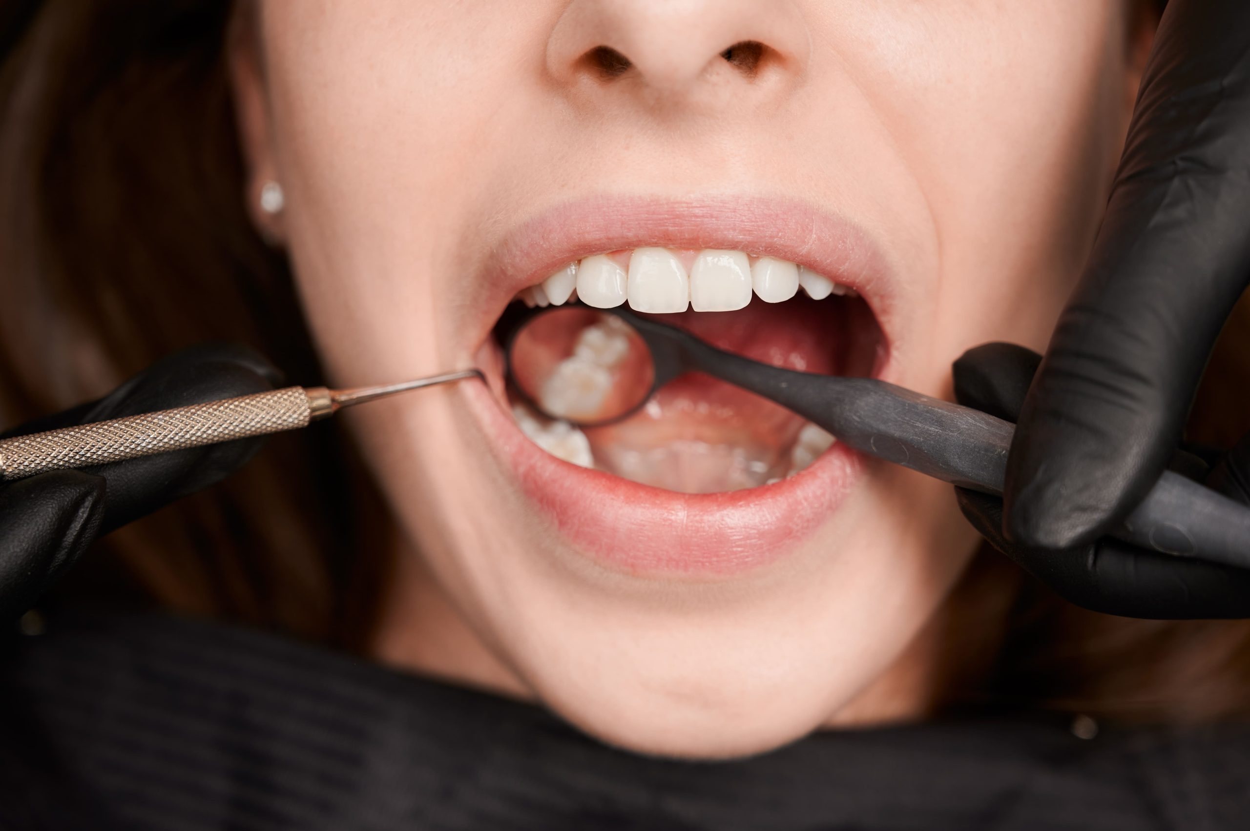 ¿Qué es el sarro dental, por qué se forma y cómo eliminarlo? sarro-en-los-dientes